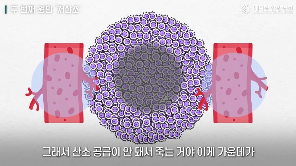 암 전이의 원인 중 하나인 저산소 환경을 설명하는 자료 화면