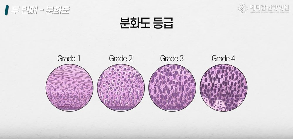 병리 조직검사에서 확인하는 분화도 등급을 설명하는 자료