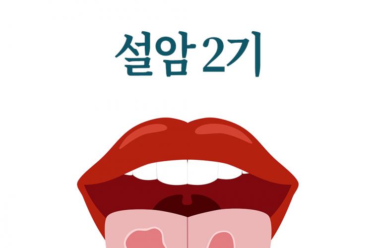 설암2기